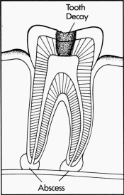 An abscessed (infected) tooth caused by tooth decay